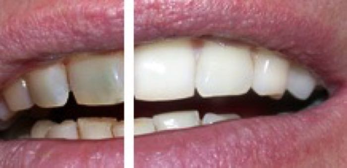 Bleaching