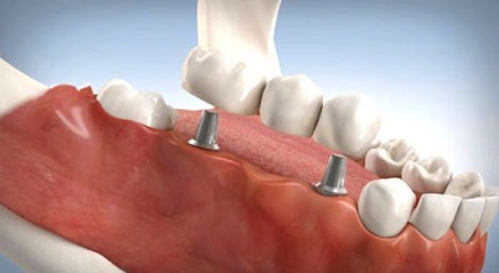 Implantatbruecke